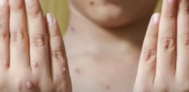 URGENTNO! SZO poziva na hitno delovanje u Evropi zbog majmunskih boginja