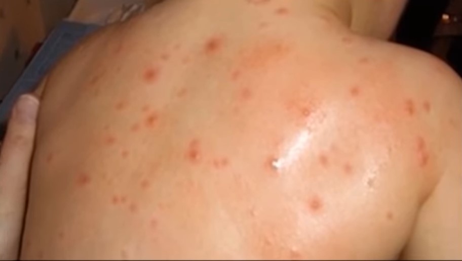 MAJMUNSKE BOGINJE STIŽU U CRNU GORU! Ugroženiji muškarci i HIV pozitivne osobe!