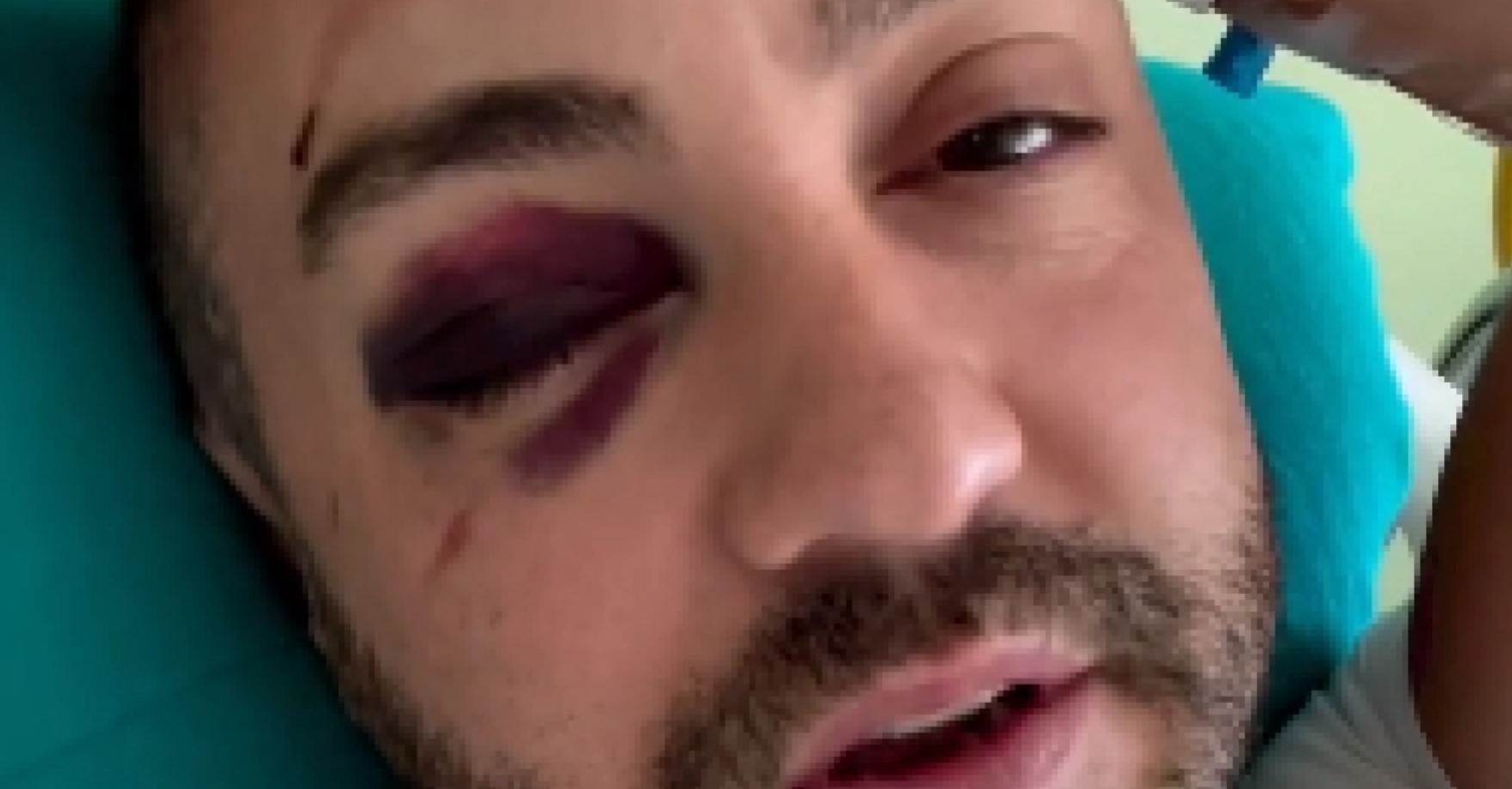 SVE JE SMRSKANO, MORA OPERACIJA Teško povređen crnogorski komičar koji je oduševio Novaka Đokovića: Pukla mu čeona kost