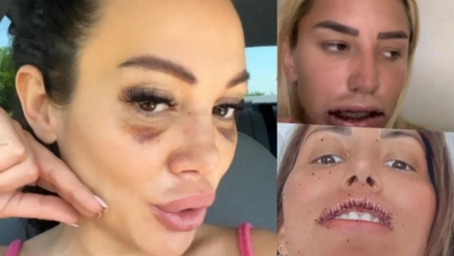 ZBOG LJEPOTE UMALO IZGUBILE GLAVU Ovo su poznate dame koje su otišle pod nož i rešile se silikona, a jedna jedva preživela