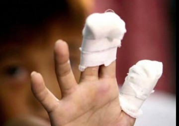 Petarda teško povrijedila dječaka iz Berana