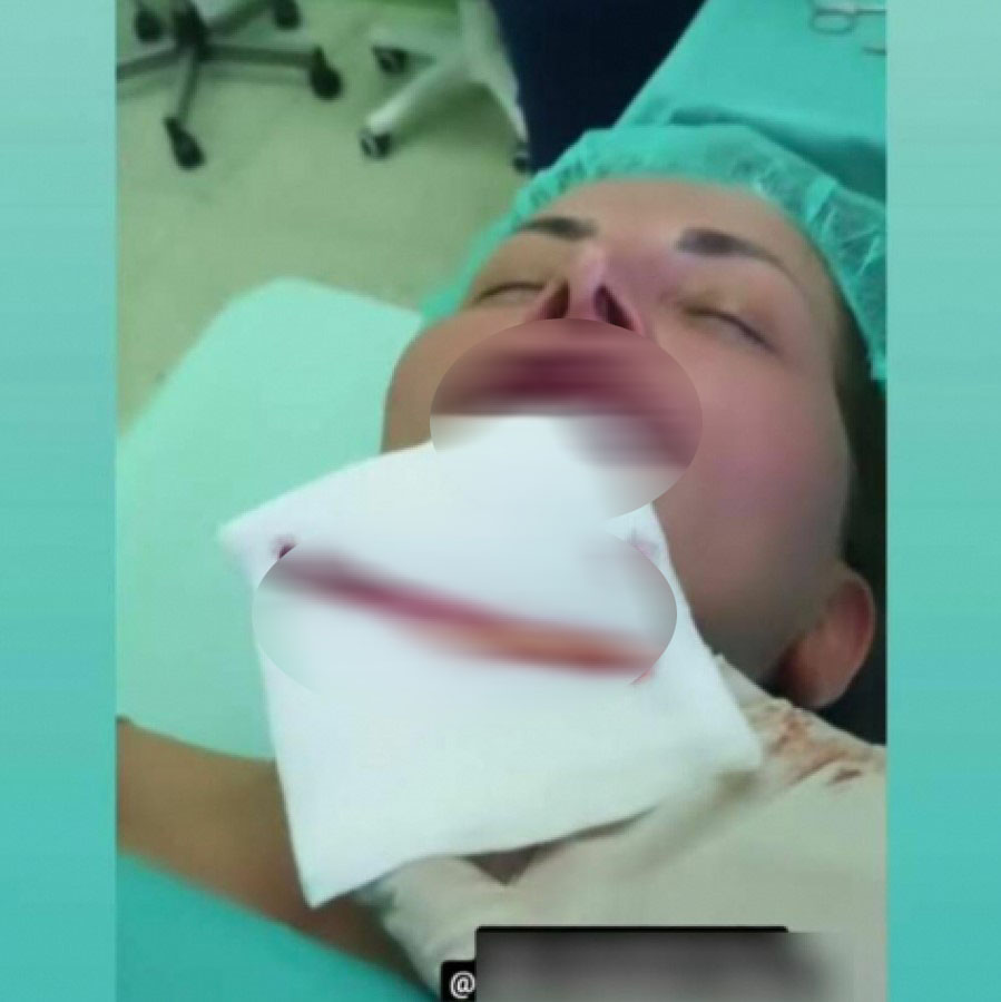 JEZIV PRIZOR! Dalila objavila fotografiju usana nakon operacije, vise konci, a ona neprepoznatljiva (FOTO)